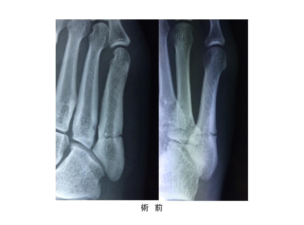 第5中足骨骨折（ジョーンズ骨折）