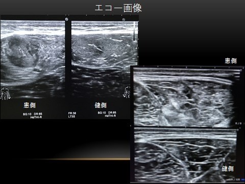 手術をしない治療
