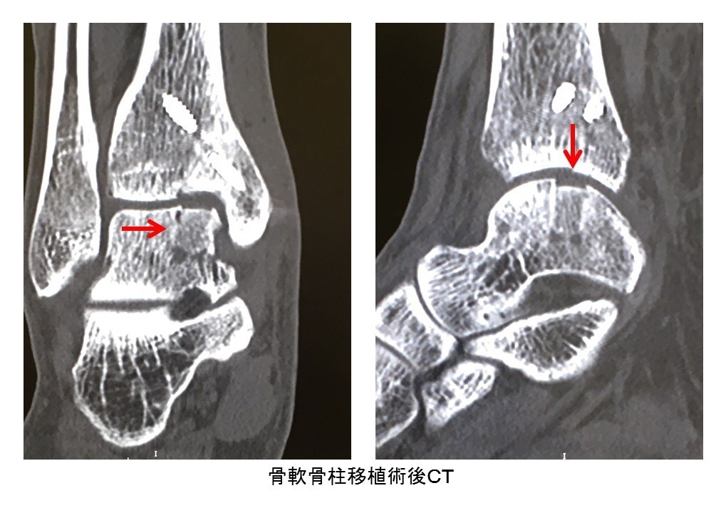 距骨骨軟骨損傷（離断性骨軟骨炎）