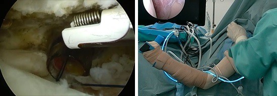 肩関節鏡の術後成績の報告