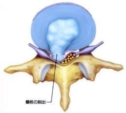 椎間板ヘルニア