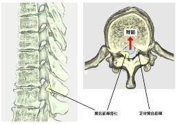 胸椎黄色靭帯骨化症