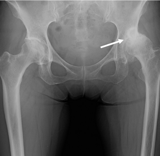 変形性股関節症