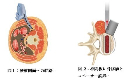 LIF 手術 内視鏡下前方固定(OLIFまたはXLIF）