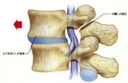 腰椎すべり症
