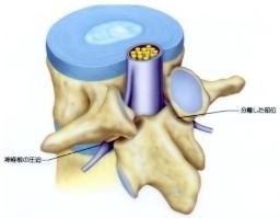 腰椎分離症