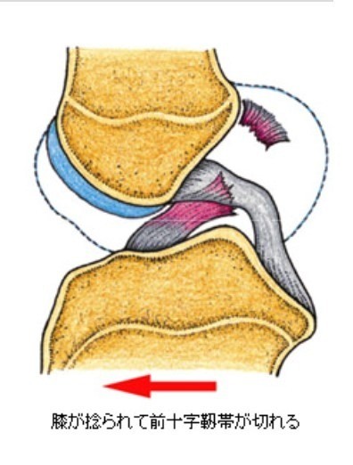 前十字靭帯断裂の手術とスポーツ復帰