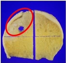 大腿骨頭壊死症