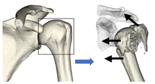 上腕骨近位端骨折