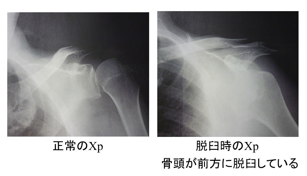 反復性肩関節脱臼、Bankart病変