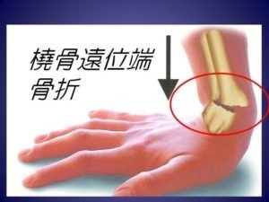 橈骨遠位端骨折