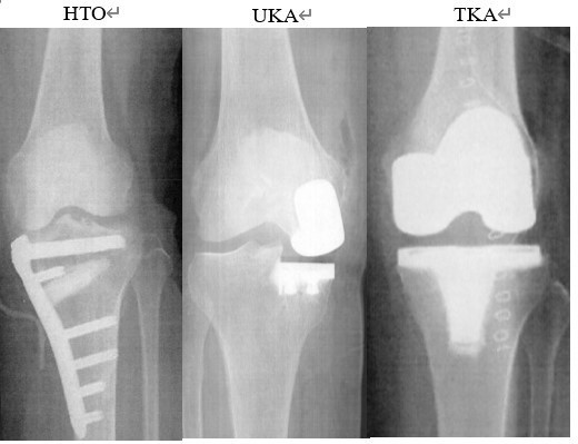 当院での膝痛に対する治療