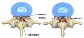 腰部脊柱管狭窄症