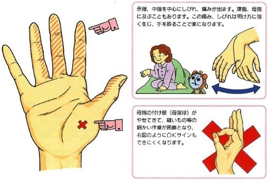 手根管症候群