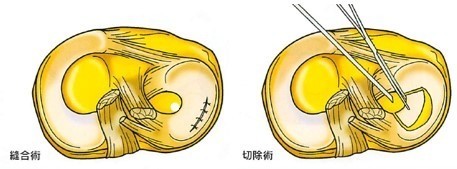 半月板損傷