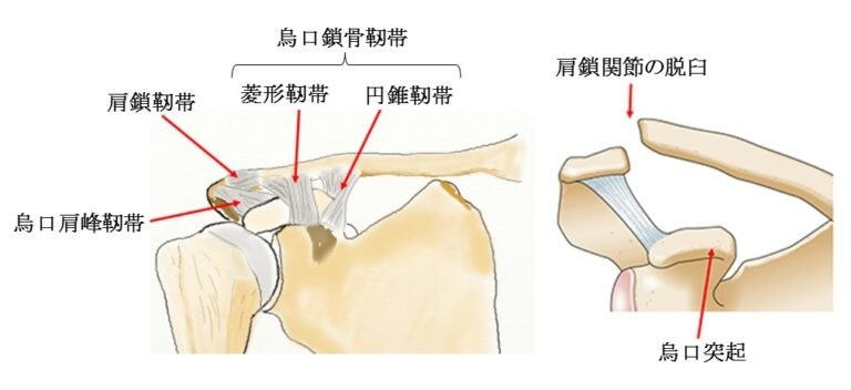 肩鎖関節脱臼