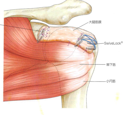 腱板広範囲断裂