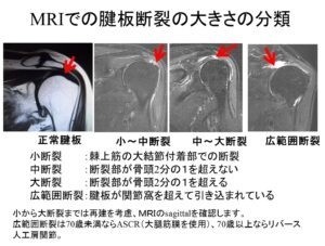 腱板断裂