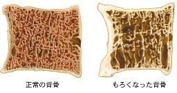 骨粗鬆症性脊椎圧迫骨折