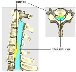 頚椎後縦靭帯骨化症