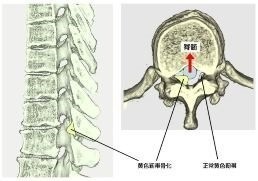 胸椎黄色靭帯骨化症